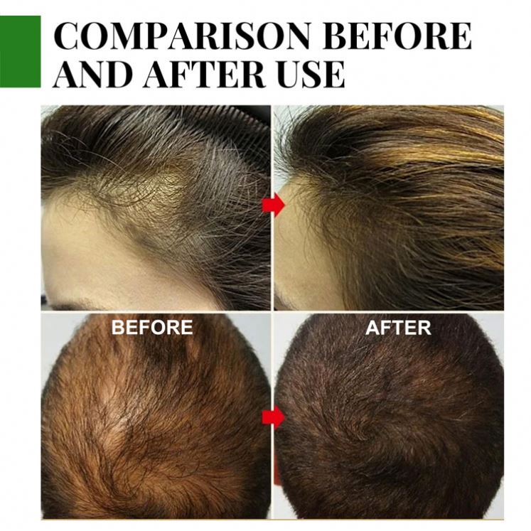 EELHOE - Hair Growth Rosemary Essential Oil