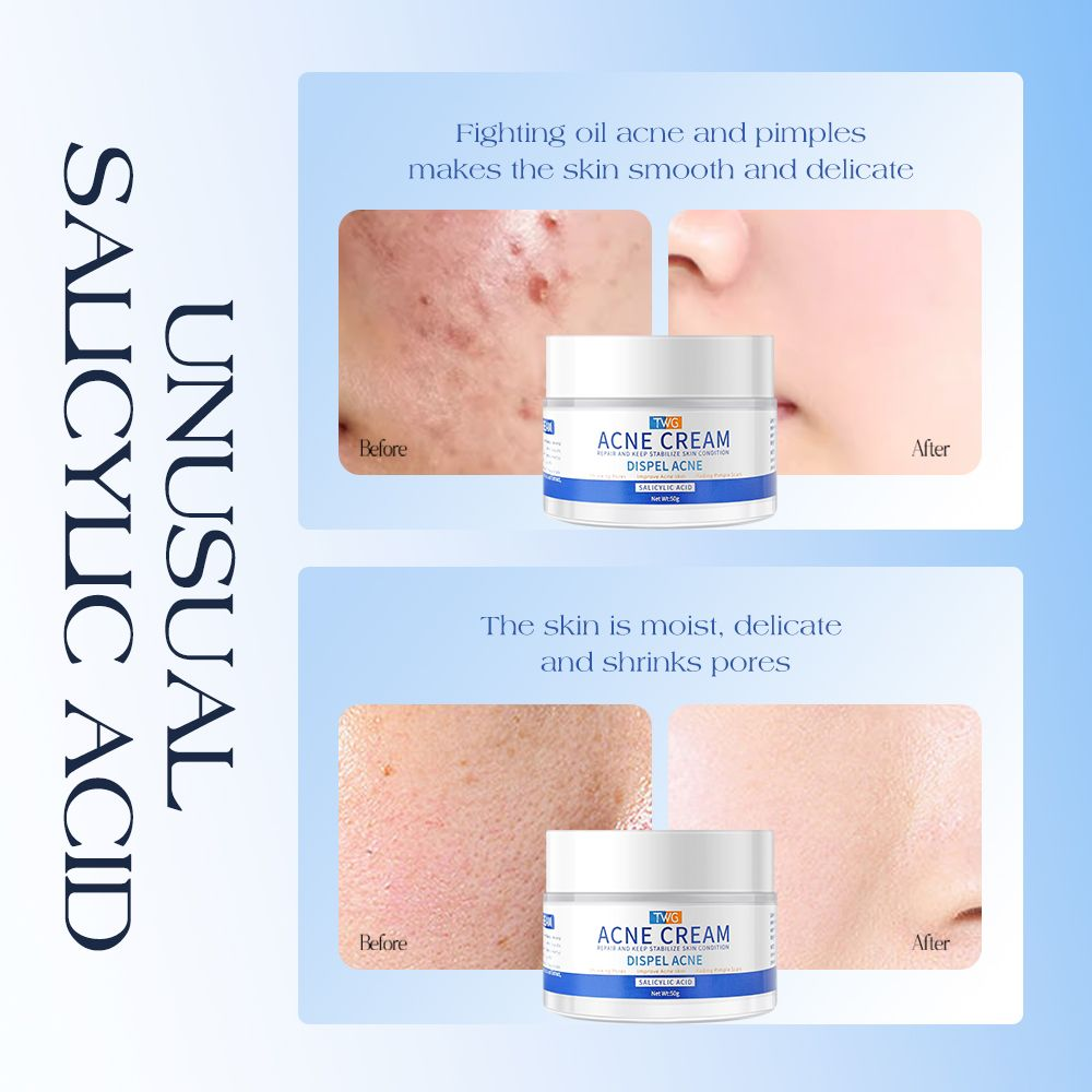 TWG Salicylic Acid Acne Cream
