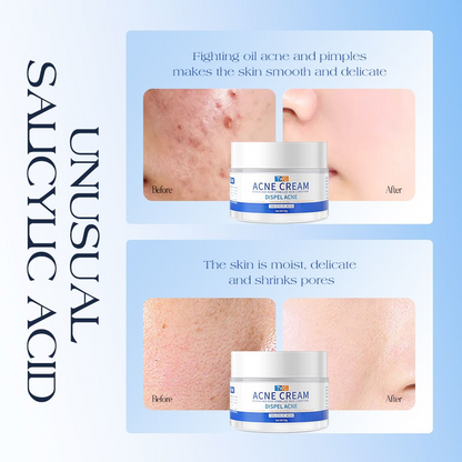 TWG Salicylic Acid Acne Cream