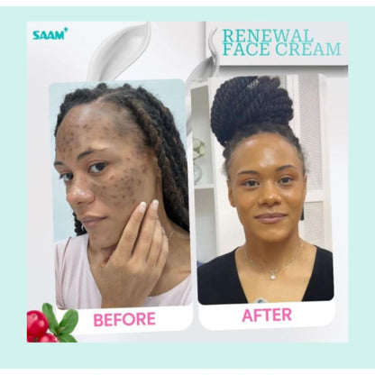 SAAM Renewal Face Cream for Melasma, Pigmentation And Dark Spots